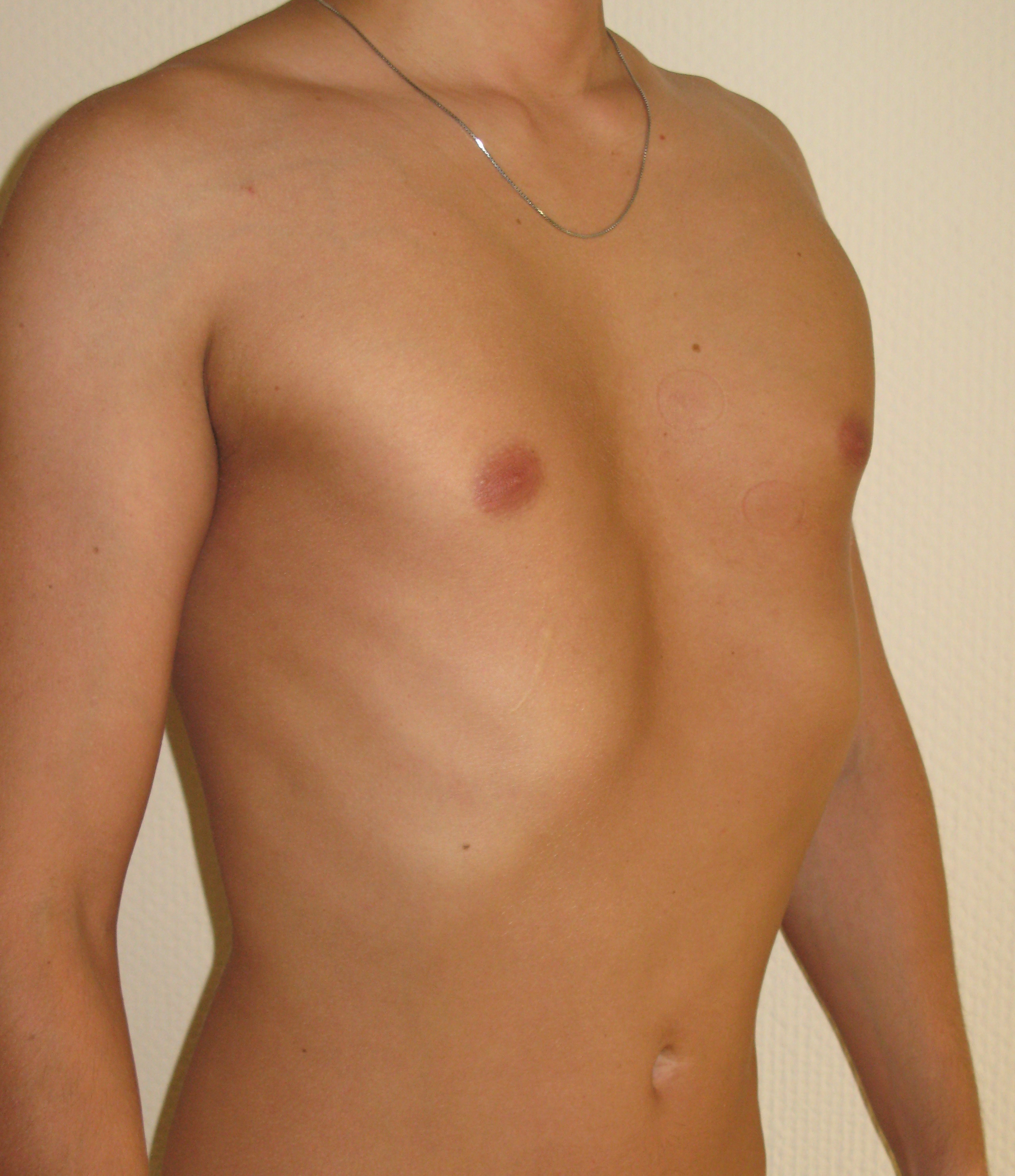 воронкообразная грудь у женщин фото 39